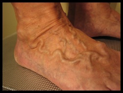 Grosses varices pied